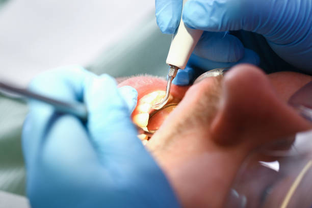 Best Emergency Root Canal Treatment in Montevlo, AL